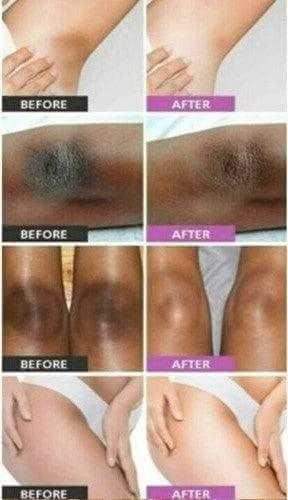 Before and after results showing improvement using Dark Inner Thighs & Armpits Solution Serum for skin tone.