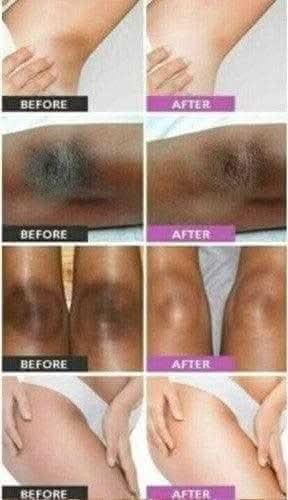 Before and after results using RoyalLuxsLLC dark inner thigh brightening serum on various skin tones