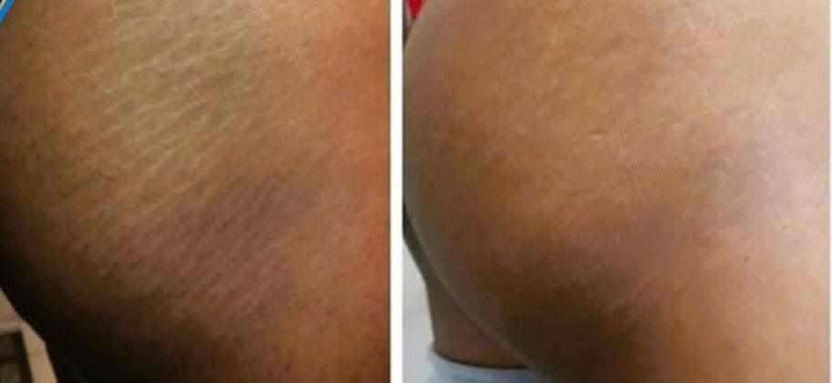 Before and after comparison showing skin improvement using natural stretch mark oil by RoyalLuxsLLC