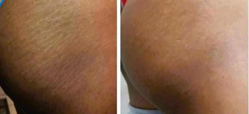 Before and after using Stretch Mark Oil 2 oz, showcasing reduced stretch marks and improved skin appearance.